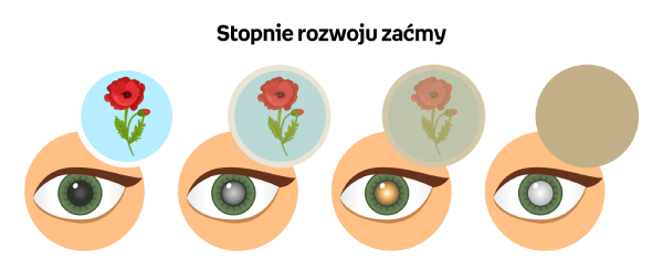 zaćma - co to jest?